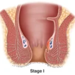 obat ambeien paling ampuh - obat ambeien stadium 1 - obat ambeien wasir - obat penyakit ambeien - cara mengobati ambeien - obat ambeien berdarah - obat pengempes benjolan ambeien