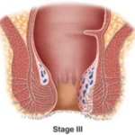 obat ambeien paling ampuh - obat ambeien stadium 3 - obat ambeien wasir - obat penyakit ambeien - cara mengobati ambeien - obat ambeien berdarah - obat pengempes benjolan ambeien